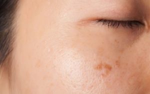 Vết thâm mụn lâu năm