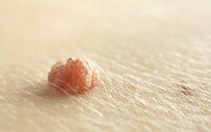 Mụn thịt dư là những khối thịt nhỏ mọc trồi lên da, ảnh hưởng nhiều tới thẩm mỹ