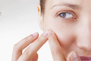 Mụn bọc ẩn dưới da cũng là một dạng mụn gây viêm nhiễm