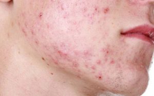 Về nguyên tắc, trị thâm mụn cho nam cũng có những nguyên tắc giống như khi trị thâm mụn cho nữ giới