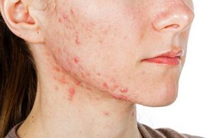 Da bị viêm lỗ chân lông