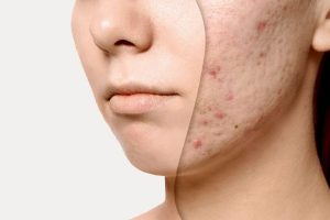 Da mặt sần sùi nhiều mụn cám