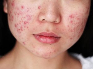 Để phát huy tối đa công dụng của kem trị mụn thì bạn cần hiểu rõ làn da của mình