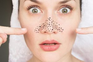 Lỗ chân lông đen ở mặt rất hay xuất hiện ở vùng mũi