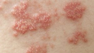 Mụn nước trên mặt