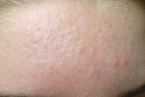Làn da gặp phải tình trạng mụn ẩn khắp khu vực trán