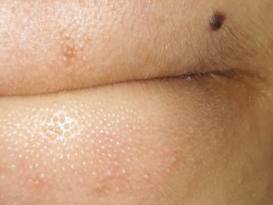 Mụn cám là vấn đề rất khó loại bỏ mà lại dễ tái phát