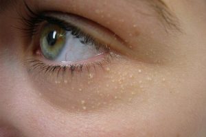 Mụn đá hay còn được biết đến là mụn thịt