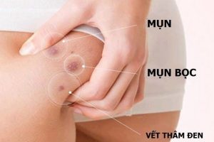 Mụn nhọt bị chai ở mông thường to và thâm
