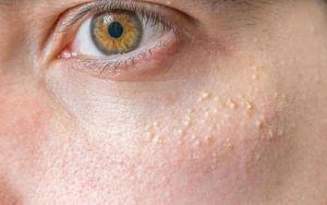 mụn thịt quanh mắt