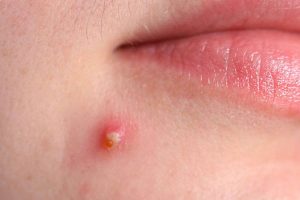 Mụn bọc chín là khi cồi mụn khô, nhô lên cao khỏi bề mặt da, sờ vào không thấy đau nhức