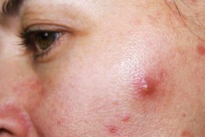 Mụn bọc sưng không đầu cũng là một loại của mụn bọc
