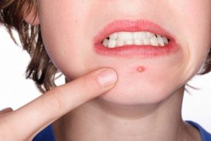 Mụn bọc xuất hiện ở bất kỳ độ tuổi này sau dậy thì