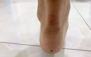 Nốt ruồi nơi gót chân trái mang theo ý nghĩa tốt đẹp về vận mệnh