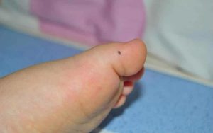 Nốt ruồi ở ngón chân cái