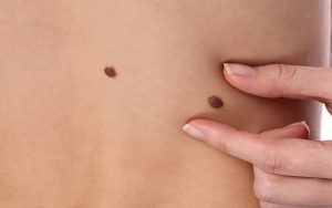Nốt ruồi son ở vị trí gần bụng