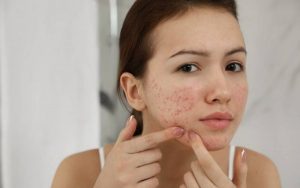 Kiên trì rửa mặt bằng nước ấm kết hợp cùng phương pháp điều trị mụn thì tình trạng mụn sẽ được cải thiện