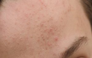 Mụn ẩn và mụn đầu đen khiến da sần sùi và mất thẩm mỹ