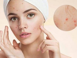 Điều trị mụn tại spa