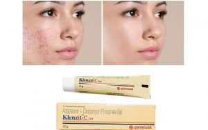 Kem trị mụn Klenzit C - giải pháp cho làn da mụn tuổi dậy thì