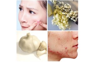 Trị mụn bọc bằng tỏi có tốt không?