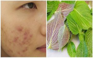 Xông mặt có tác dụng giúp lỗ chân lông giãn nở, hỗ trợ làm sạch da mặt