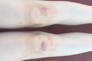 Có những cách trị sẹo thâm lâu năm ở chân nào?