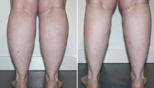 Bắp chân to gây mất thẩm mỹ vóc dáng