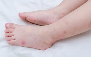 Vết thâm lâu năm khiến nhiều chị em rất tự ti