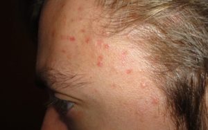 Mụn xuất hiện ở thái dương nghĩa là chế độ ăn uống của bạn không tốt