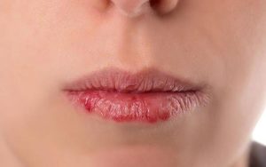 Rất nhiều người gặp phải tình trạng phun môi bị khô bong tróc