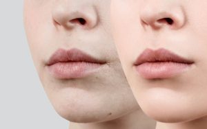 Nhiều nguyên nhân khiến đôi môi sau khi phun không như mong đợi