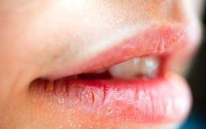 Môi bong sớm nguyên nhân là do môi bị khô, thiếu độ ẩm