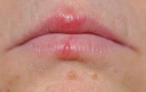 Môi mụn nước có thể dẫn đến những hậu quả nghiêm trọng