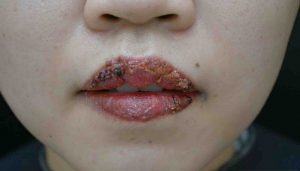Xăm môi bị nhiễm trùng
