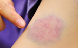 Mật gấu có công dụng chính là giảm đau và làm tan các vết bầm tím trên da