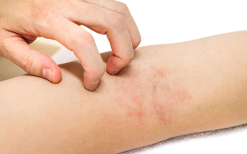 Dừng ngay sử dụng tinh chất triệt lông nếu bị dị ứng