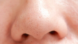 Mụn đầu đen thường xuyên hiện trên mũi