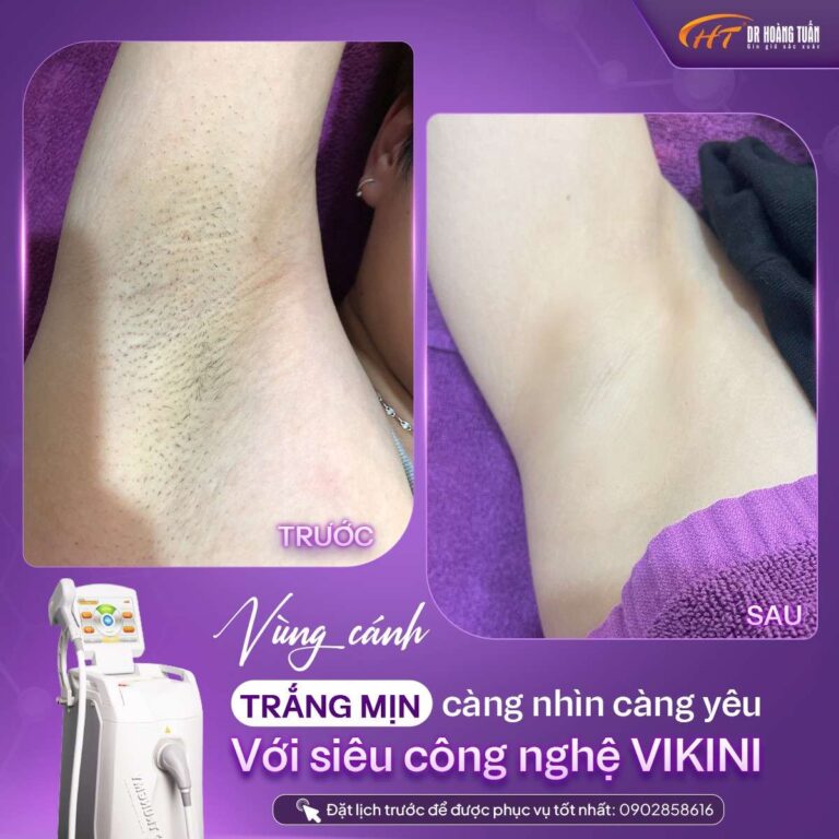 Thẩm mỹ Hoàng Tuấn - sự lựa chọn hoàn hảo cho dịch vụ triệt lông uy tín