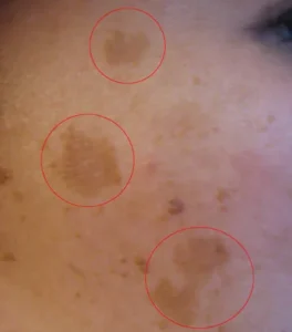 melasma on face treatment