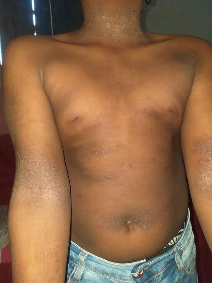 eczema, itchy skin, dermatitis, skin irritation, pruritus