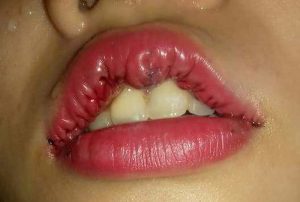 Môi bị dị dạng sau phẫu thuật môi