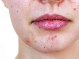 Mụn sưng đỏ và vết thâm là vấn đề đáng lo ngại của hầu hết mọi người