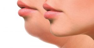 Nọng cằm - Nỗi khổ không của riêng ai