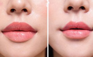 Phẫu thuật môi dày thành môi mỏng