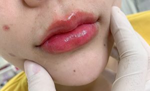 Tiêm môi trái tim là một xu hướng làm đẹp gần đây, được các chị em ưa chuộng
