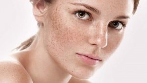 Chăm sóc da mặt bị nám tại nhà là điều vô cùng cần thiết