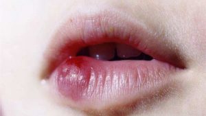 Tiêm filler kém chất lượng khiến môi bị vón cục