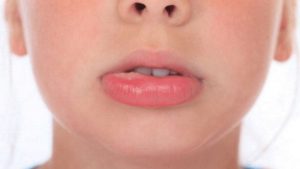 Sau khi tiêm môi có thể bị sưng phồng nhẹ vài ngày