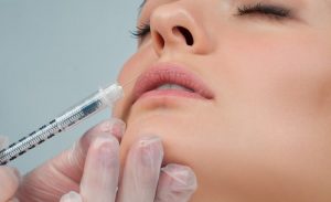 Tiêm filler môi giữ được bao lâu, có vĩnh viễn không được quan tâm